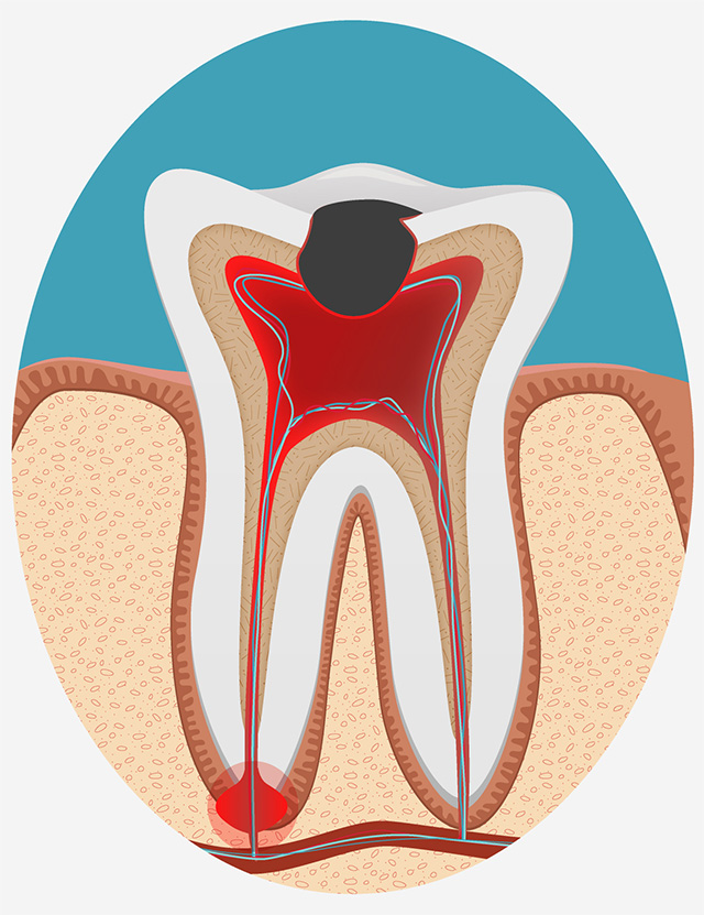 歯の神経の除去（抜髄）